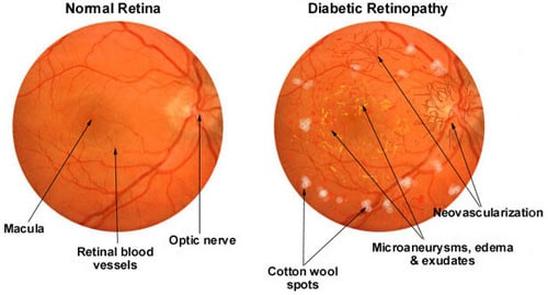 diagram of normal retina and eye of person with Diabetic Retinopathy