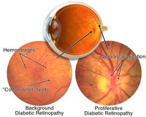 diagram of muscles and nerves in eye showing diabetic retinopathy