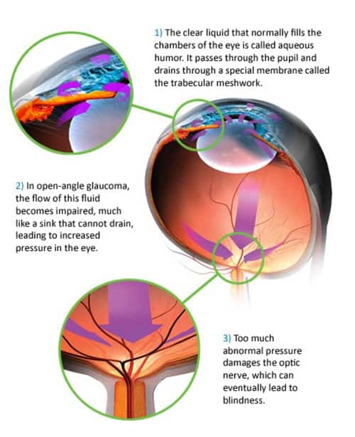 diagram showing the eye and describing the causes of glaucoma