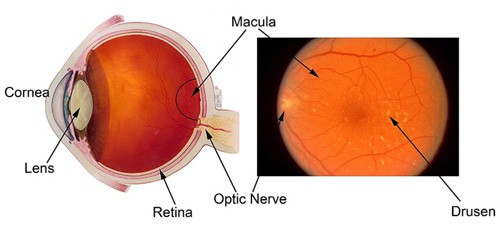 labelled diagram of eye showing macular degeneration