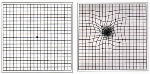 macular degeneration depicted on a grid