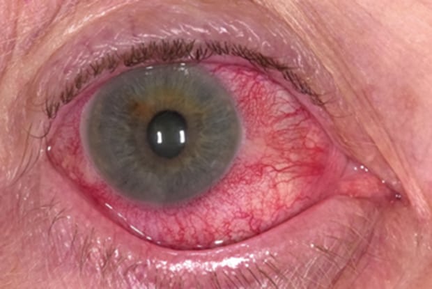 closeup of eye with acuteritis
