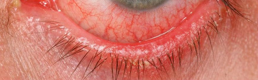 close up of eye with blepharo conjunctivitis