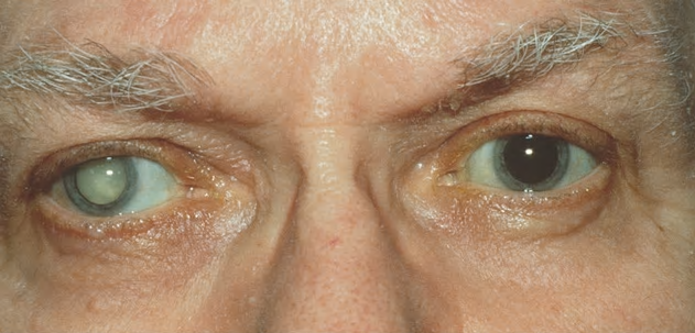 example of man with cataract in one eye