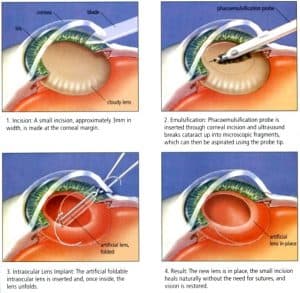 cataracts lens cataract typically intra ocular