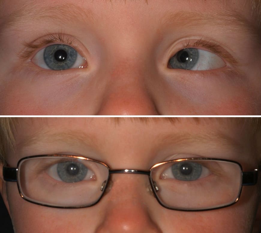 collage of child with convergent squint with and without glasses
