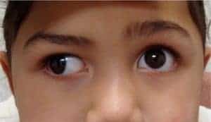 child with exo tropia