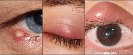 close up collage of eye with external stye and chalazion