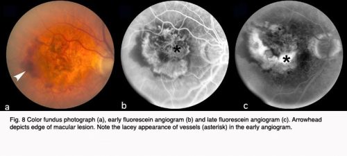 Fluorescein Angiography comparison