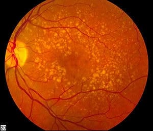 close up of eye with middle age macular degeneration