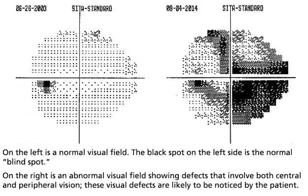 comparison of normal visual field and and an abnormal visual field