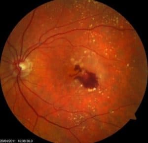 close up of eye with wet macular degeneration