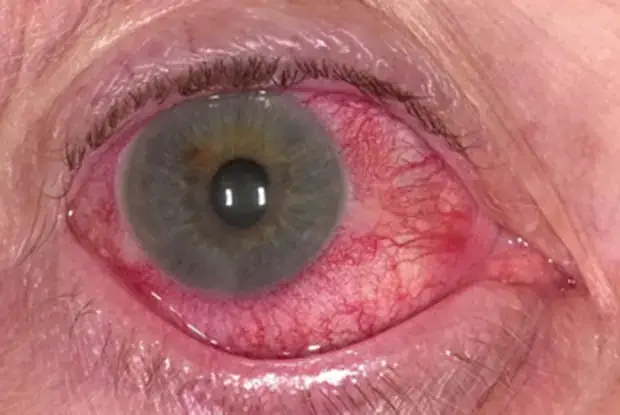 closeup of eye with acuteritis