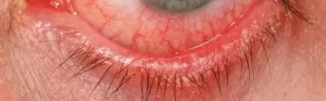 close up of eyelid with blepharo conjunctivitis